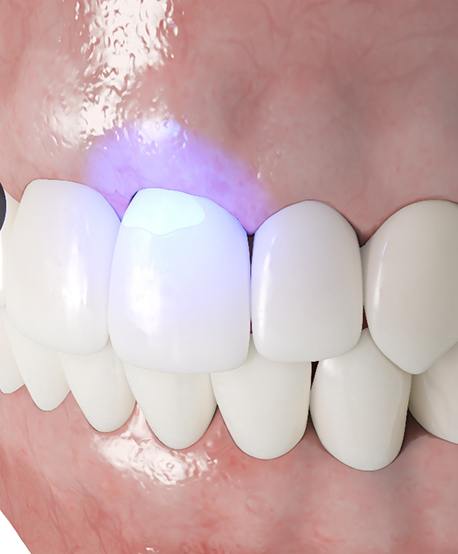 Illustration of cosmetic dental bonding in Westbury