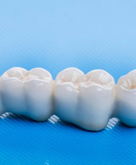 Dental bridge