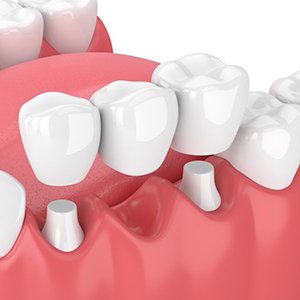 Exploded Illustration of traditional bridge and treated teeth