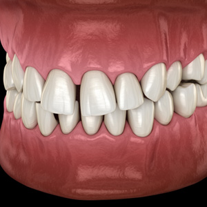 Illustration of gapped teeth