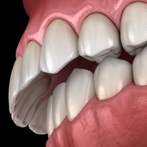 Illustration of an overbite