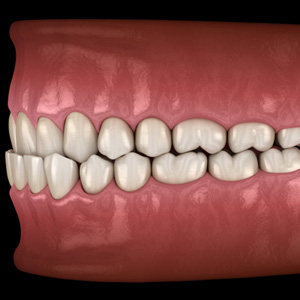 Illustration of an underbite