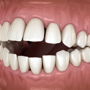 Illustration of an open bite