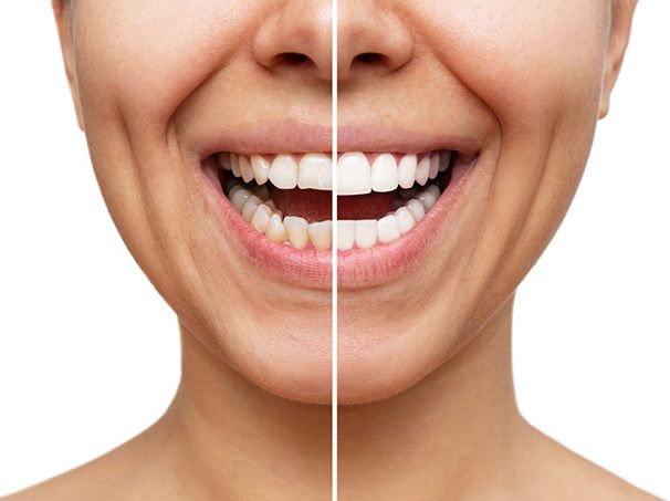 A woman before and after getting veneers