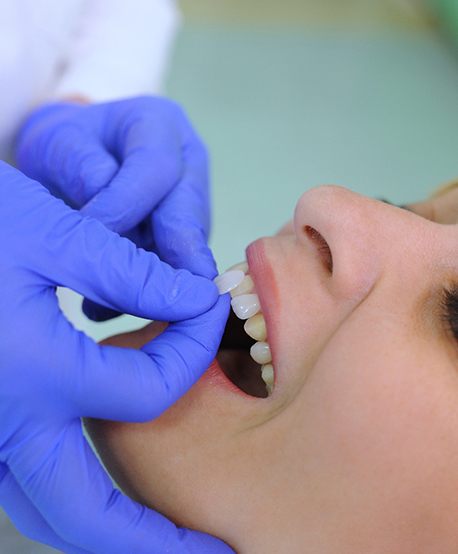 A dentist attaching veneers to a woman’s teeth