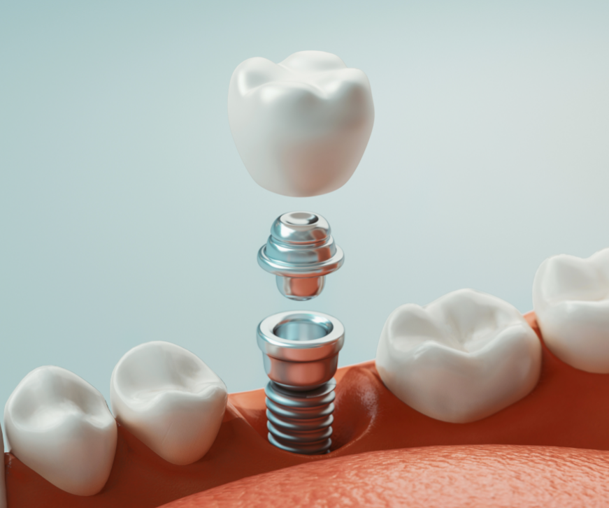 3D image of a dental implant