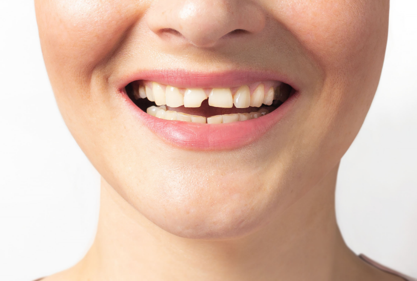 Woman smiling with chipped tooth