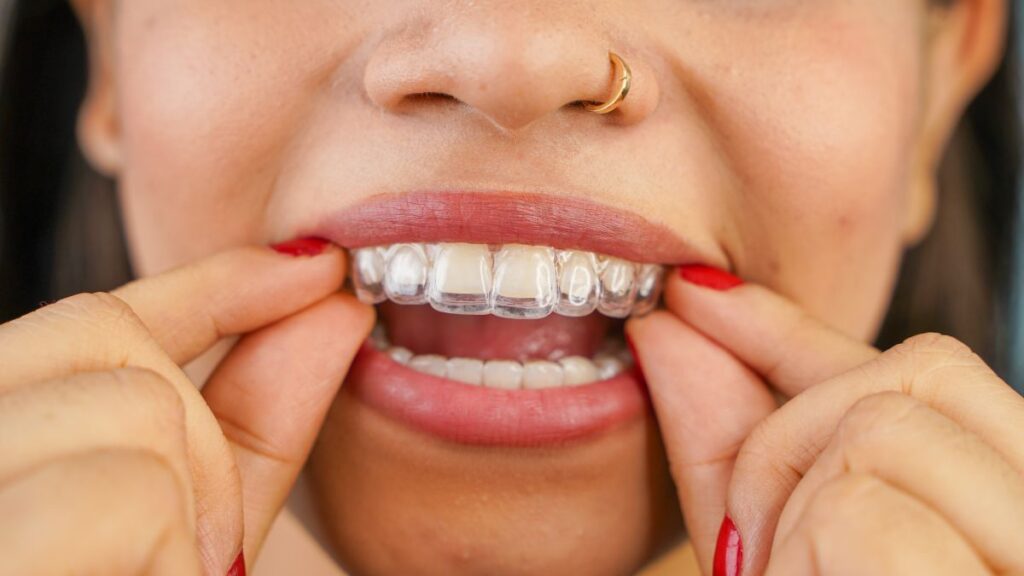 A woman putting on an Invisalign aligner