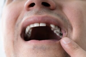 Close-up of open mouth showing missing tooth.